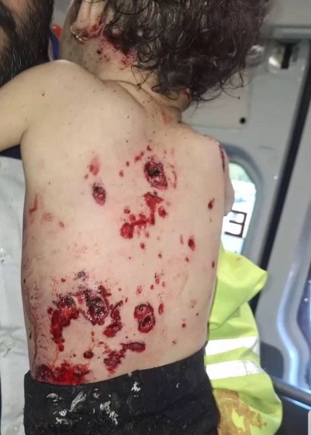 تصاویر ناراحت کننده بدن یک دختر پس از پرتاب ساچمه‌های بمب در انفجار تروریستی کرمان
