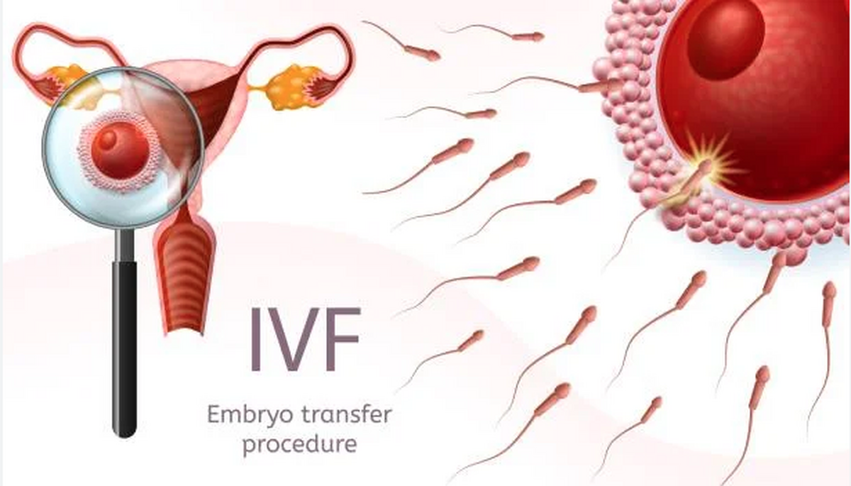 انتقال جنین در فرآیند IVF؛ چند جنین در هر بار آی وی اف منتقل می‌شود؟